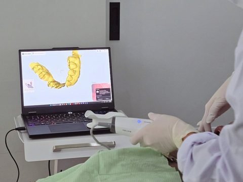 Three-dimensional intraoral scan of a dental arch during implant planning at DevelopDent Dental Clinic in Makati